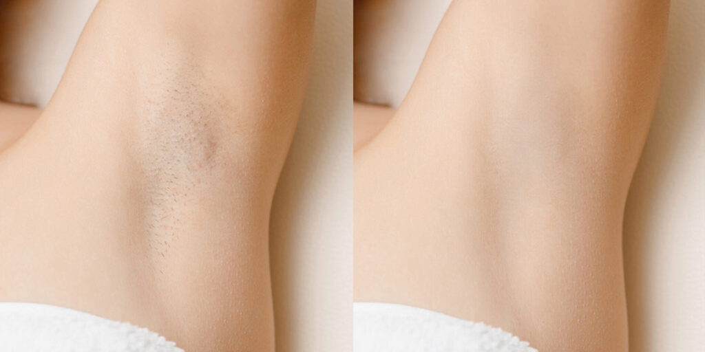 best laser hair removal in lahore